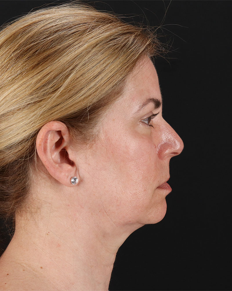 Lower Blepharoplasty Before & After Patient #8951