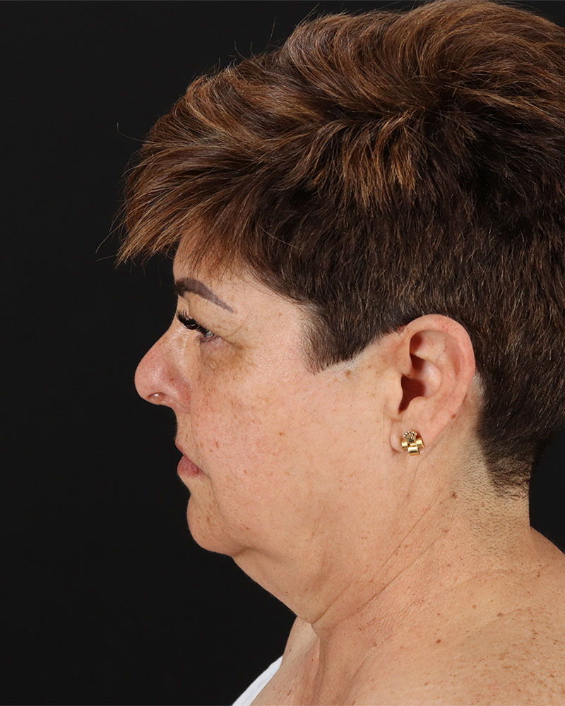 Facelift Before & After Patient #8952
