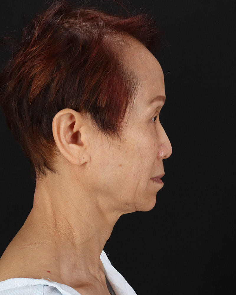 Facelift Before & After Patient #8950