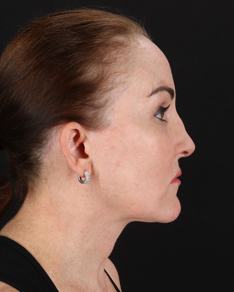 Facelift Before & After Patient #8943