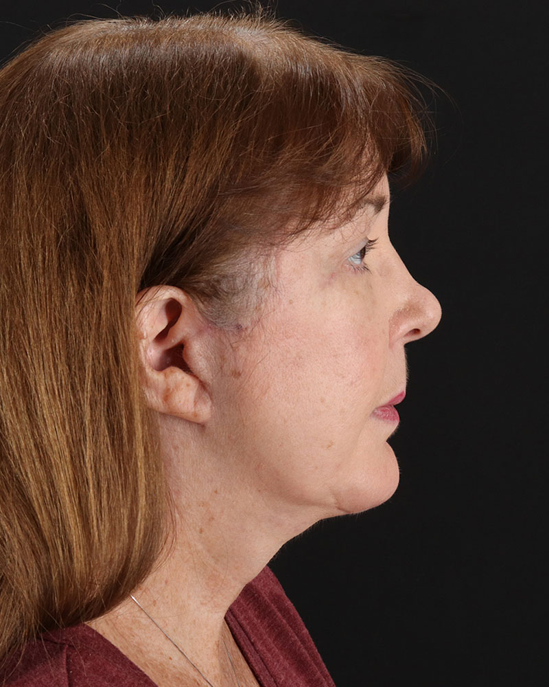 Facelift Before & After Patient #8953