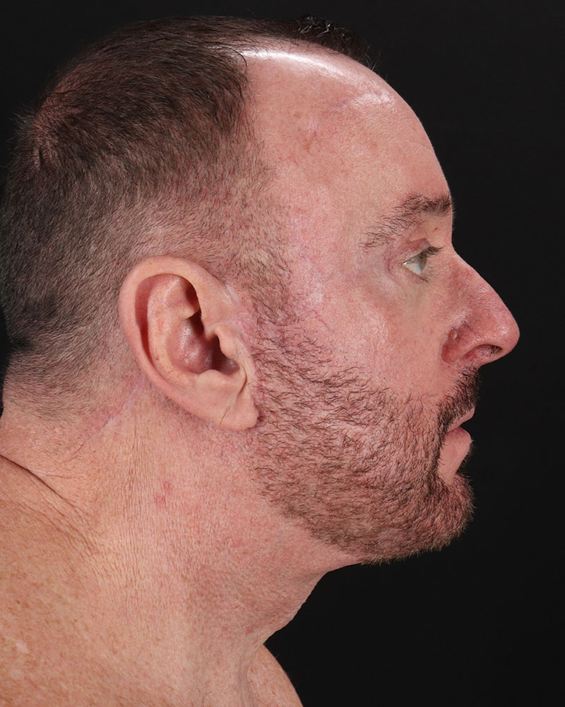 Facelift Before & After Patient #8955
