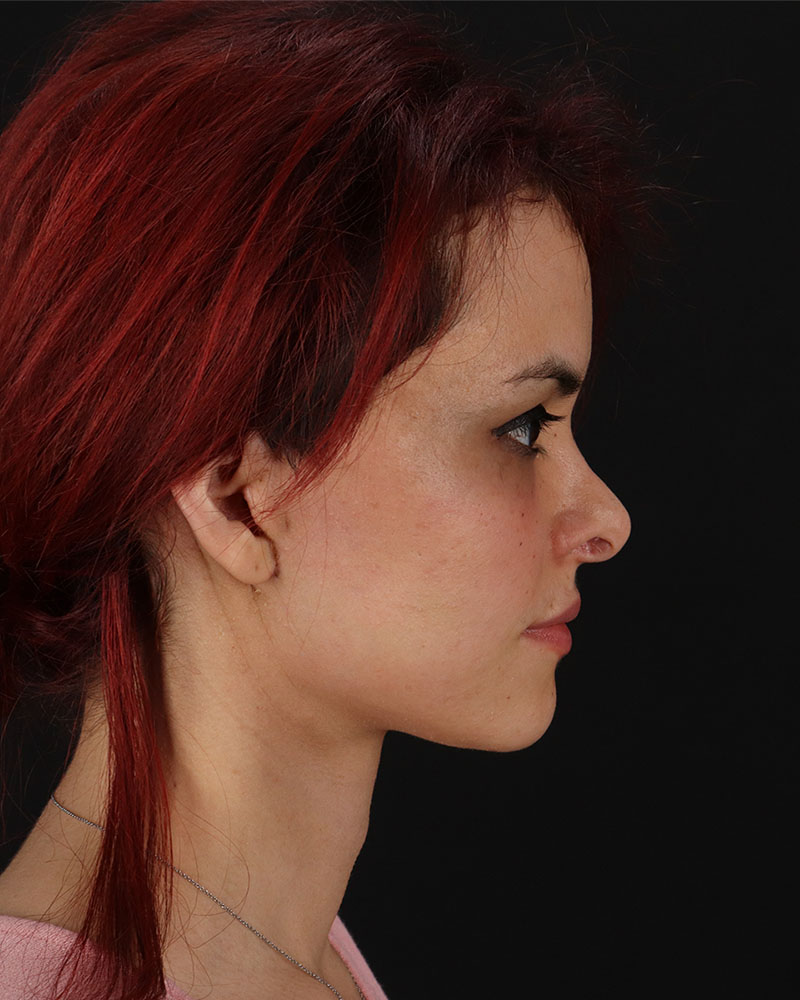 Mini Facelift Before & After Patient #8956