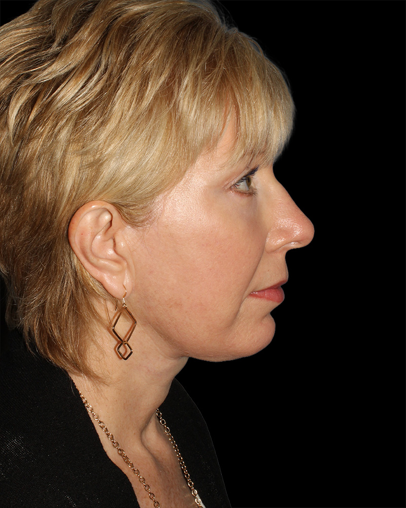 Facelift Before & After Patient #8958