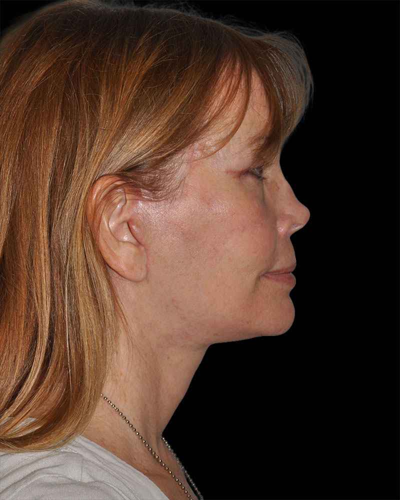 Facelift Before & After Patient #8959