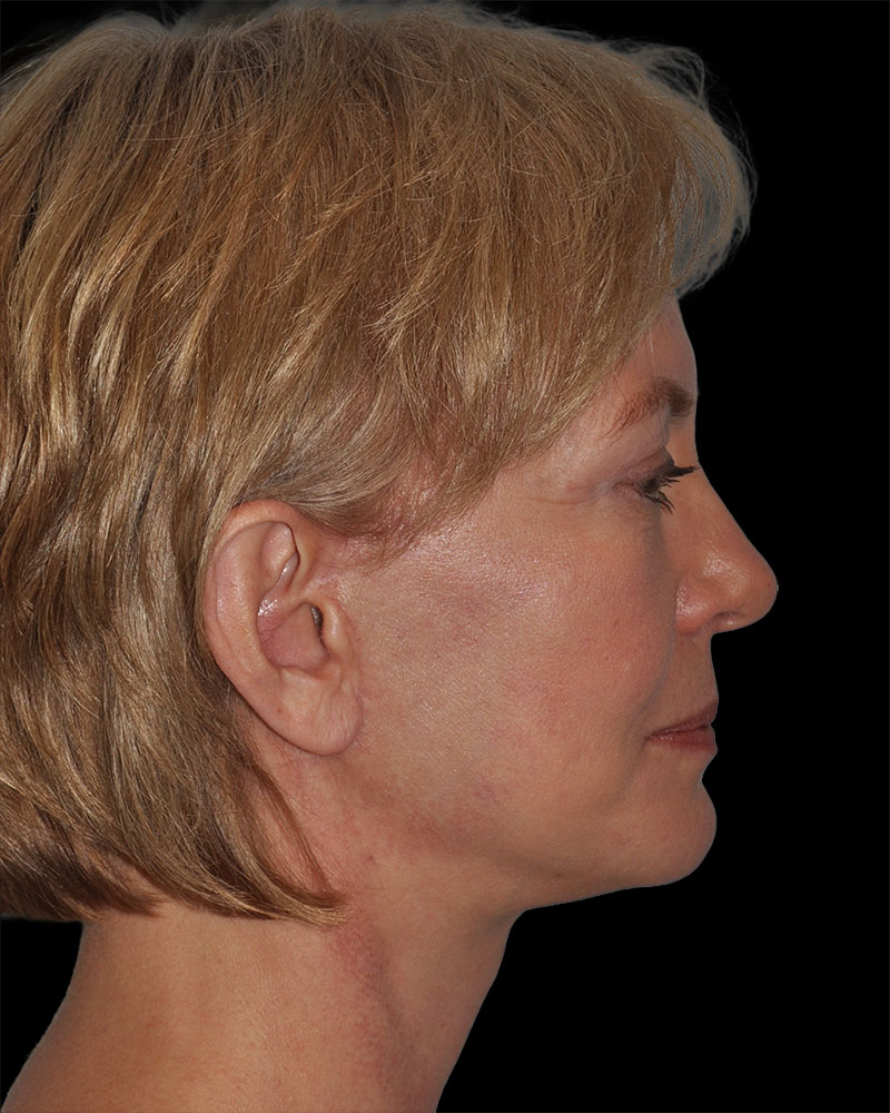 Facelift Before & After Patient #9131