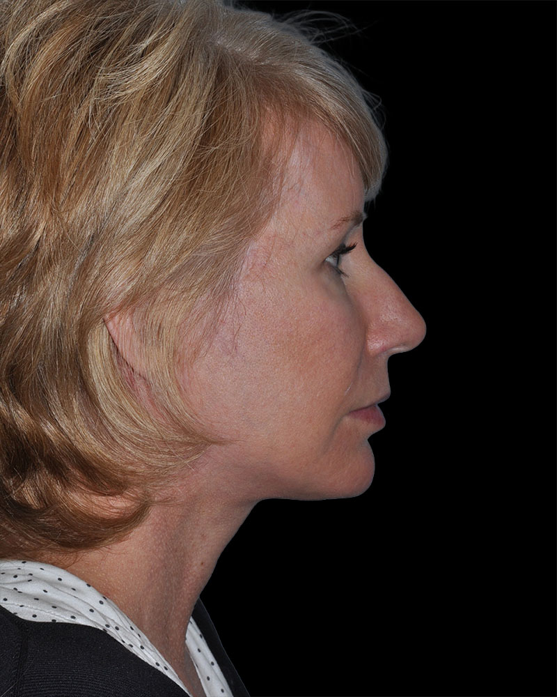 Facelift Before & After Patient #9135