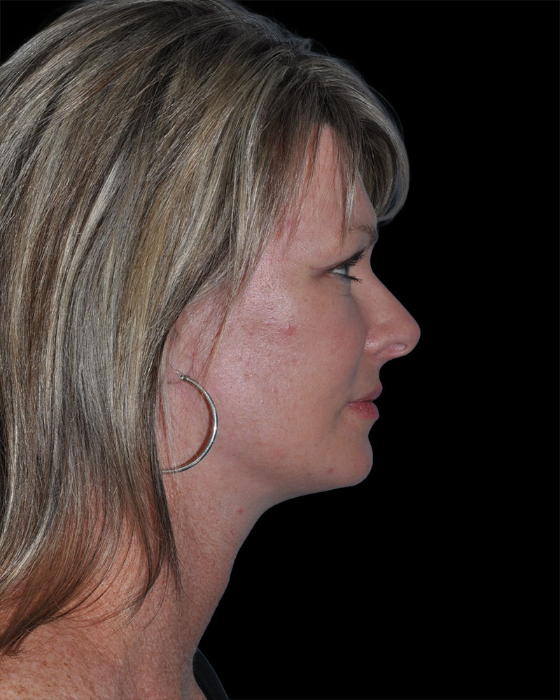 Facelift Before & After Patient #9138