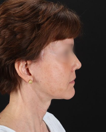 Facelift Before & After Patient #9173