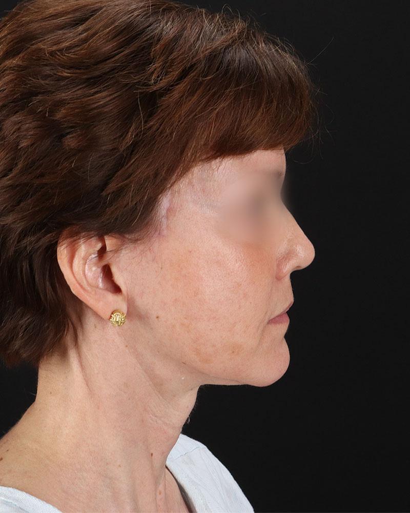 Facelift Before & After Patient #9173