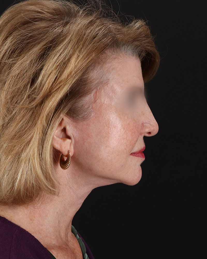 Facelift Before & After Patient #9140