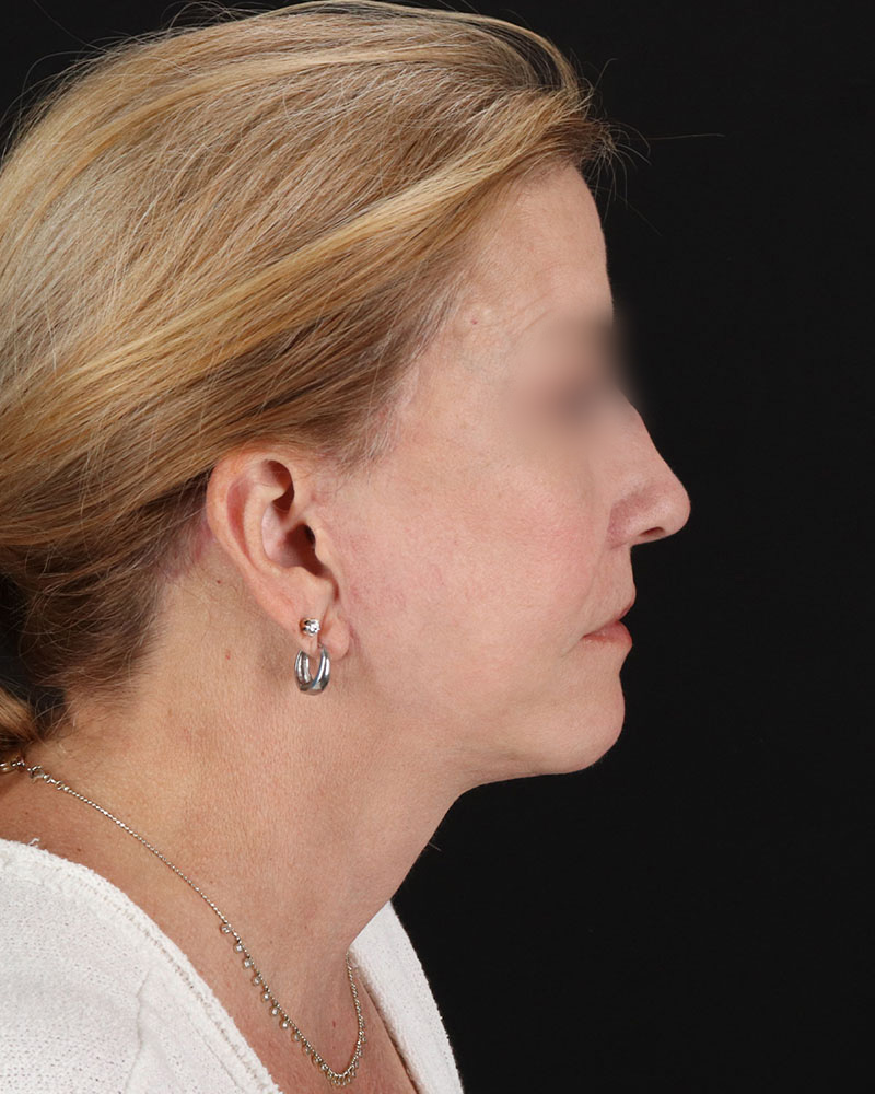 Facelift Before & After Patient #8957