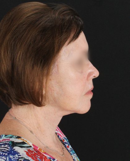 Facelift Before & After Patient #8954