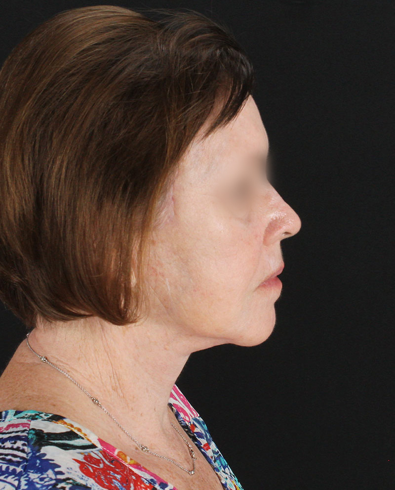 Facelift Before & After Patient #8954