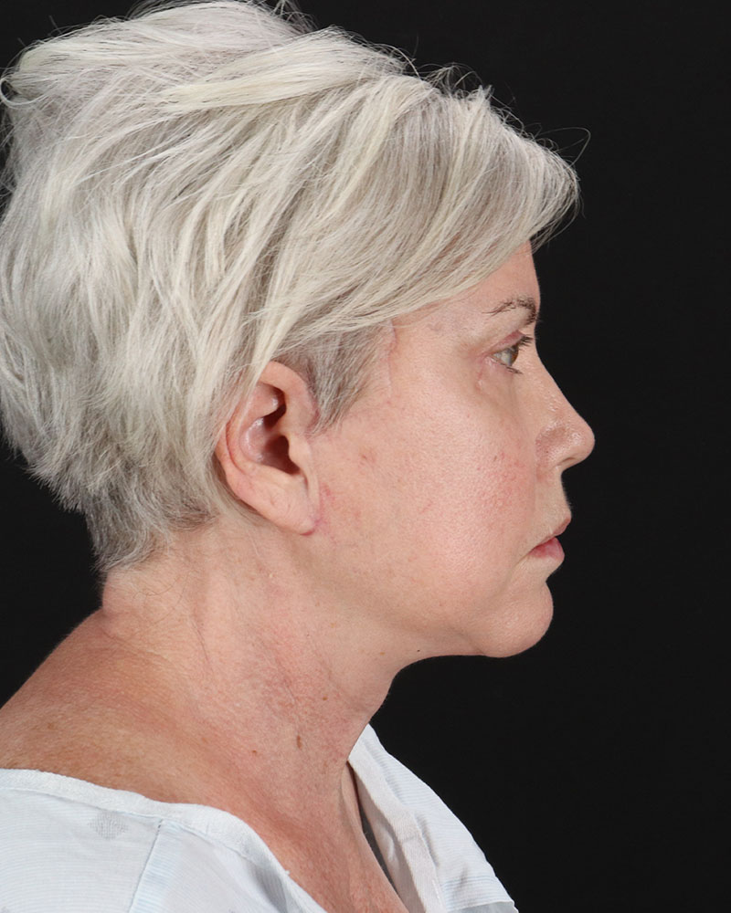 Facelift Before & After Patient #8946