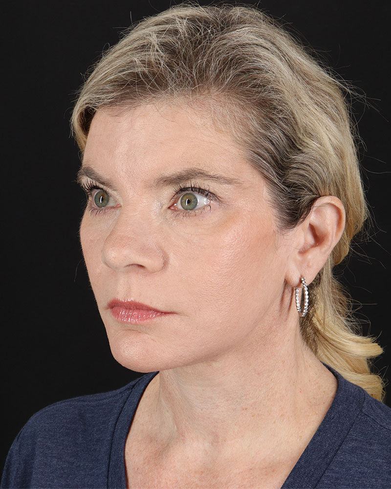 Facelift Before & After Patient #8947