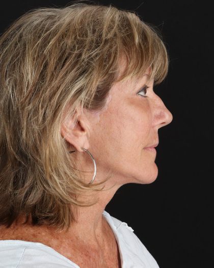 Facelift Before & After Patient #8948