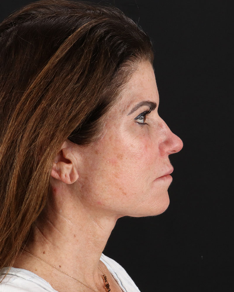 Facelift Before & After Patient #8949
