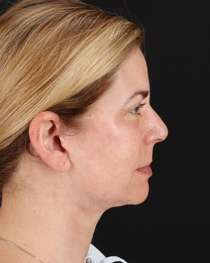 Lower Blepharoplasty Before & After Patient #8951