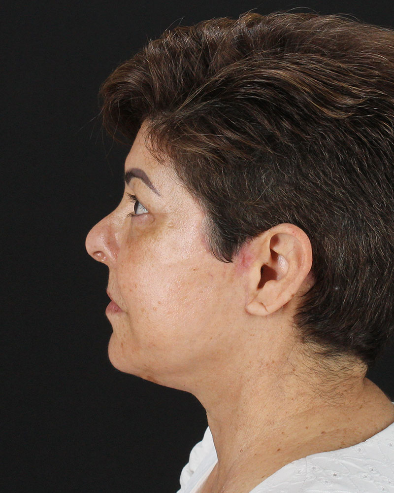 Facelift Before & After Patient #8952