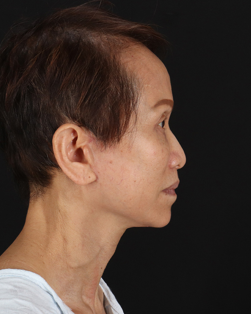 Facelift Before & After Patient #8950