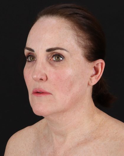 Facelift Before & After Patient #8943