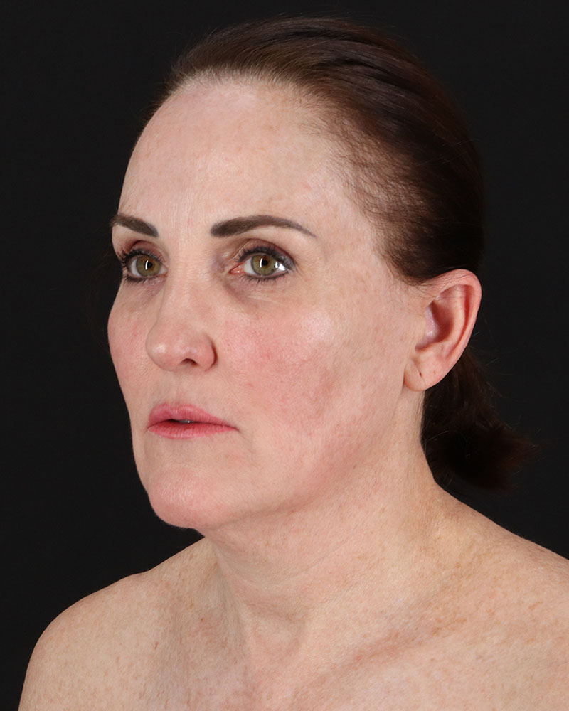 Facelift Before & After Patient #8943