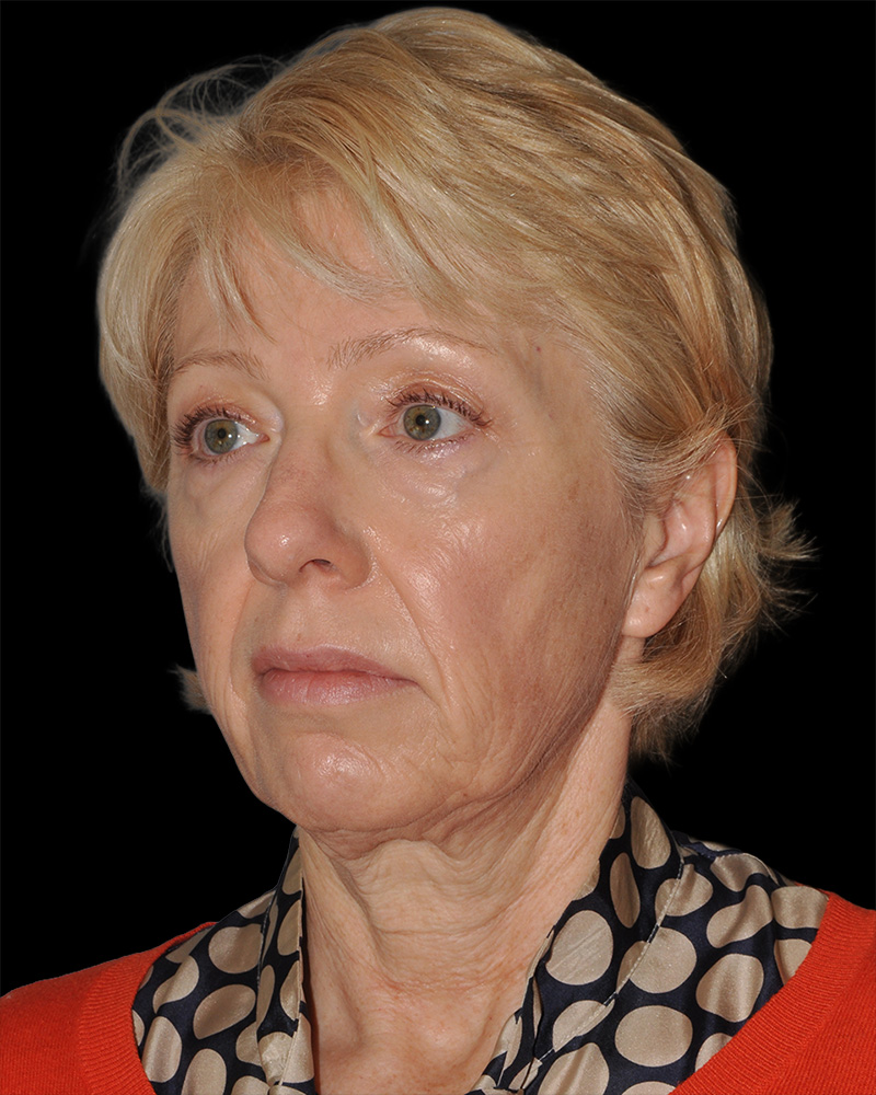 Facelift Before & After Patient #8958