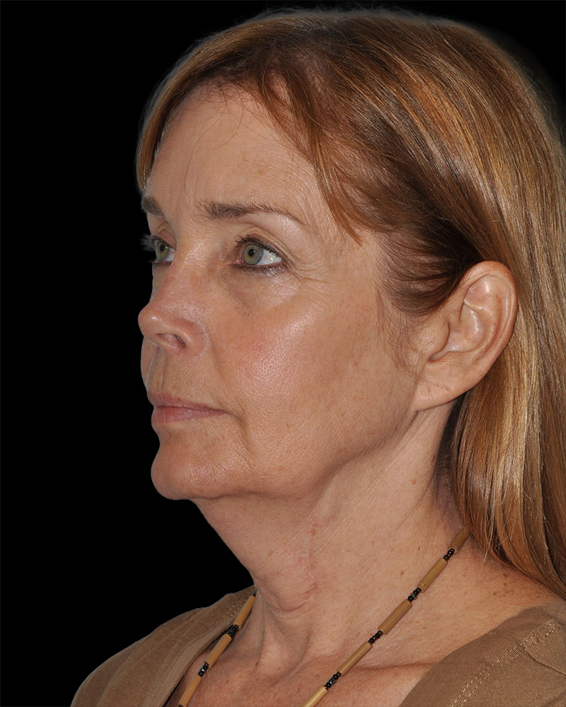 Facelift Before & After Patient #8959