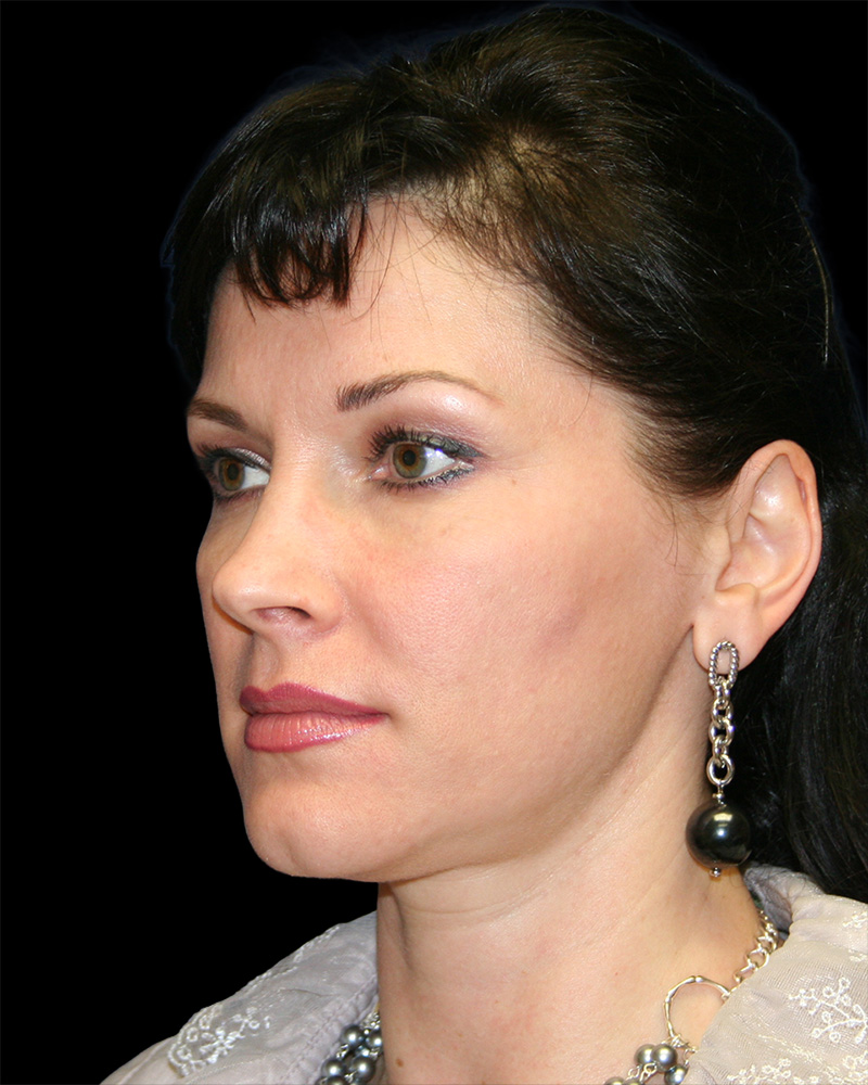 Facelift Before & After Patient #8960