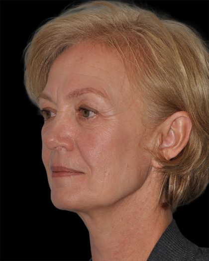 Facelift Before & After Patient #9131