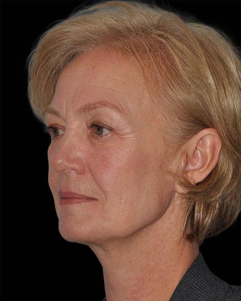 Facelift Before & After Patient #9131