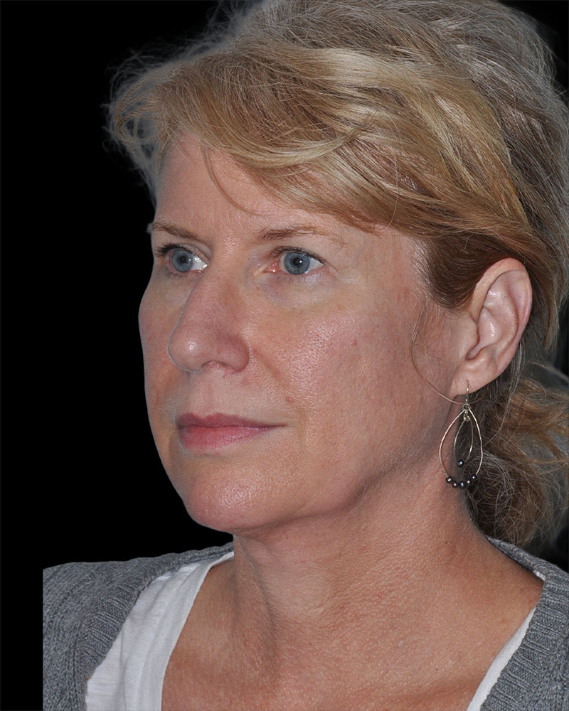 Facelift Before & After Patient #9135