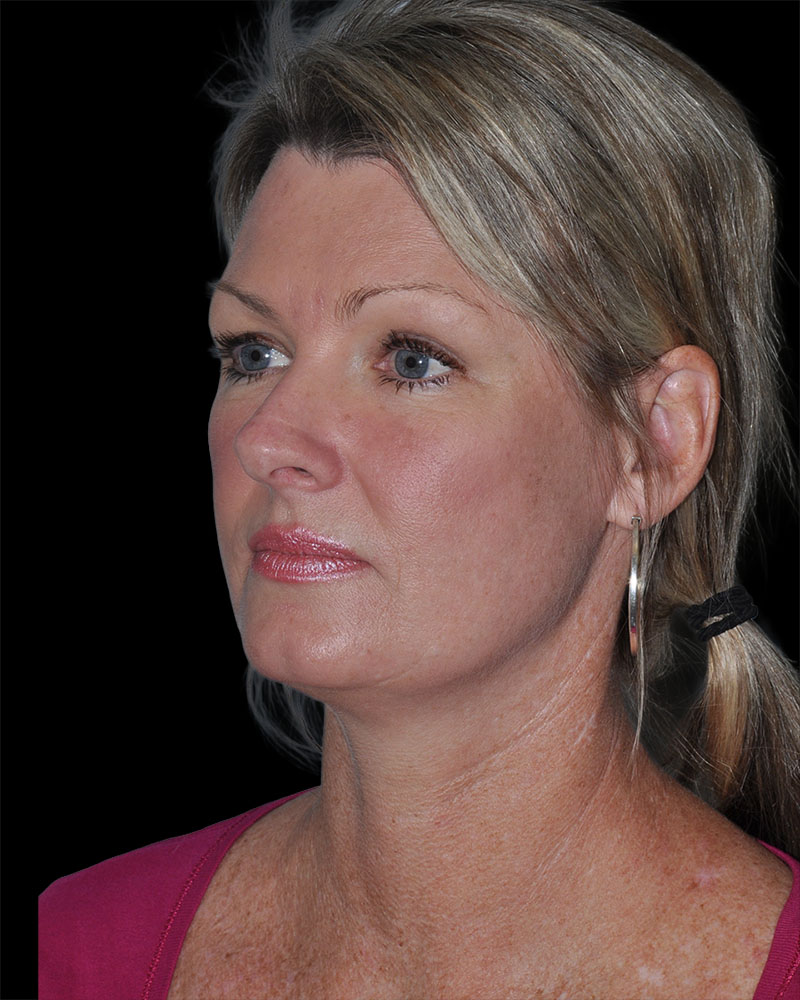 Facelift Before & After Patient #9138