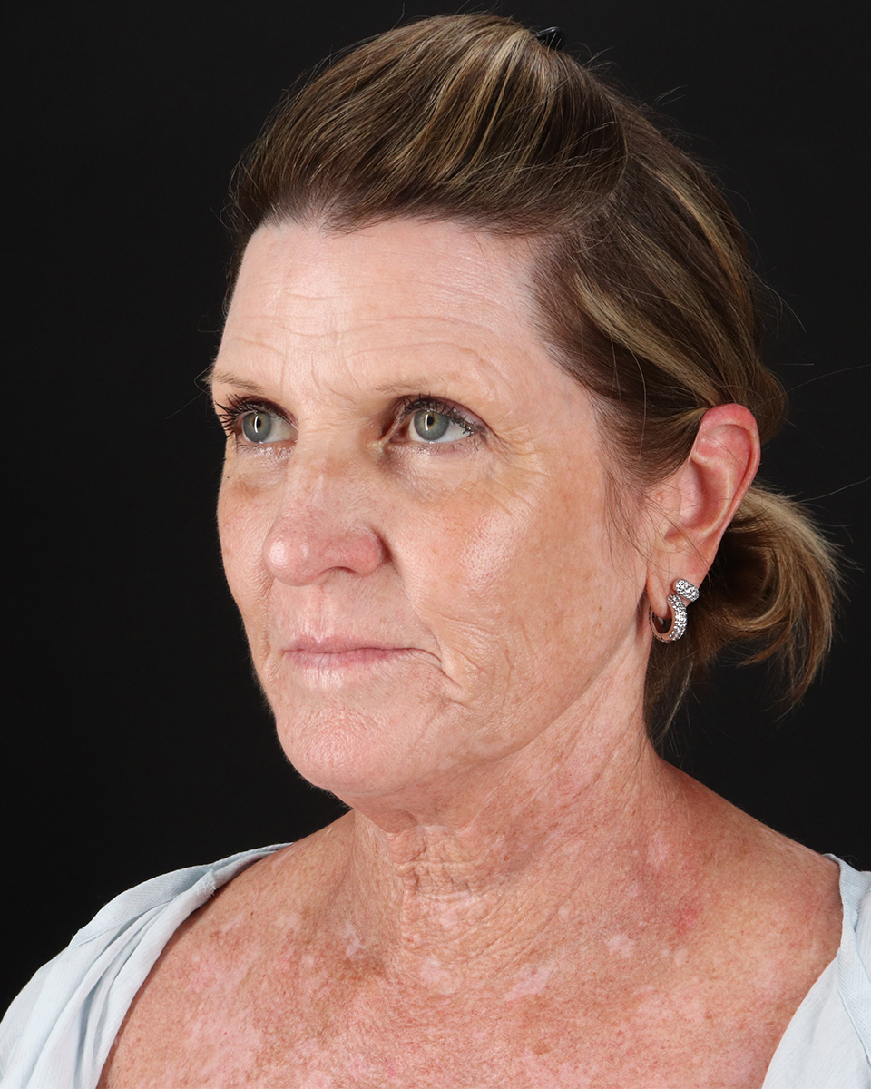 Facelift Before & After Patient #8944