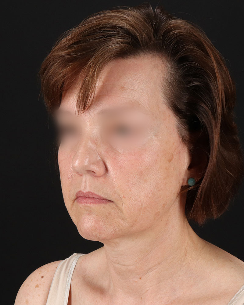 Facelift Before & After Patient #9173