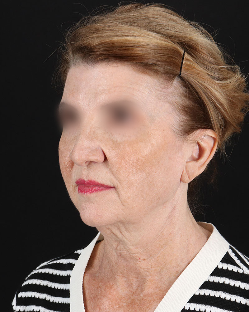 Facelift Before & After Patient #9140