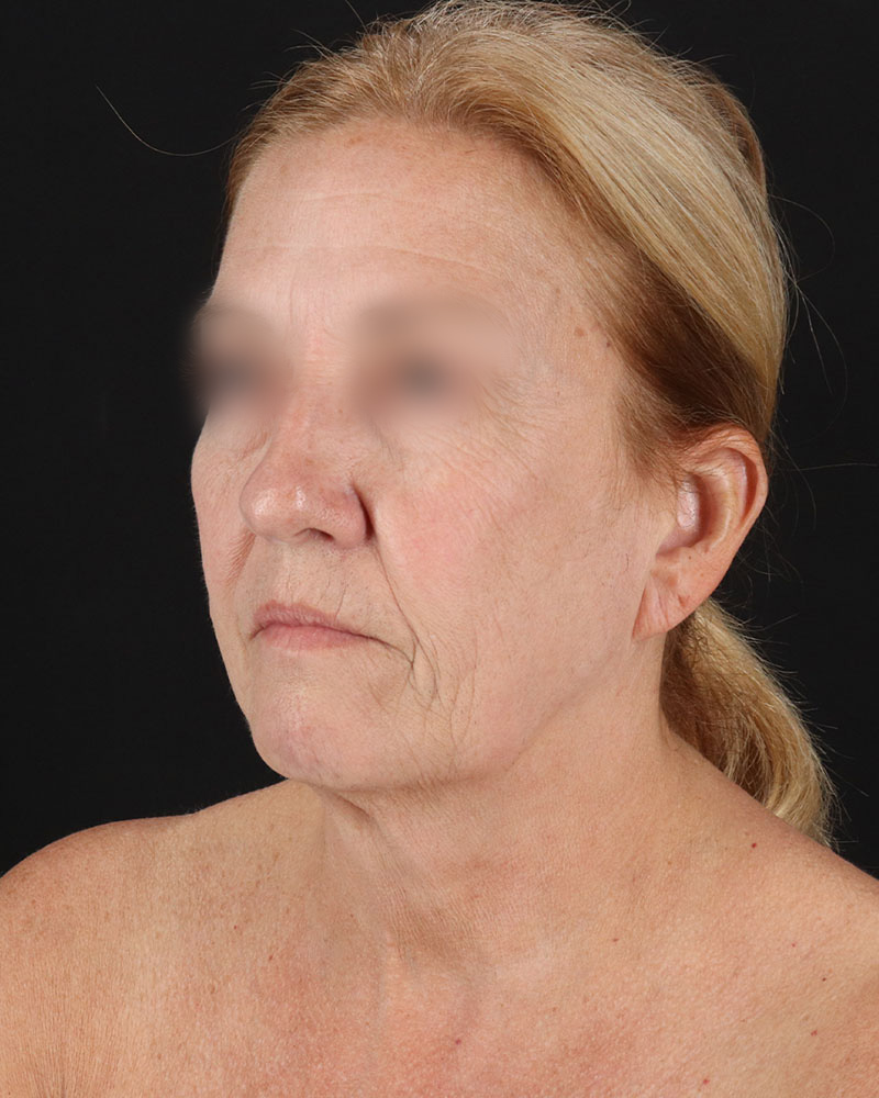 Facelift Before & After Patient #8957