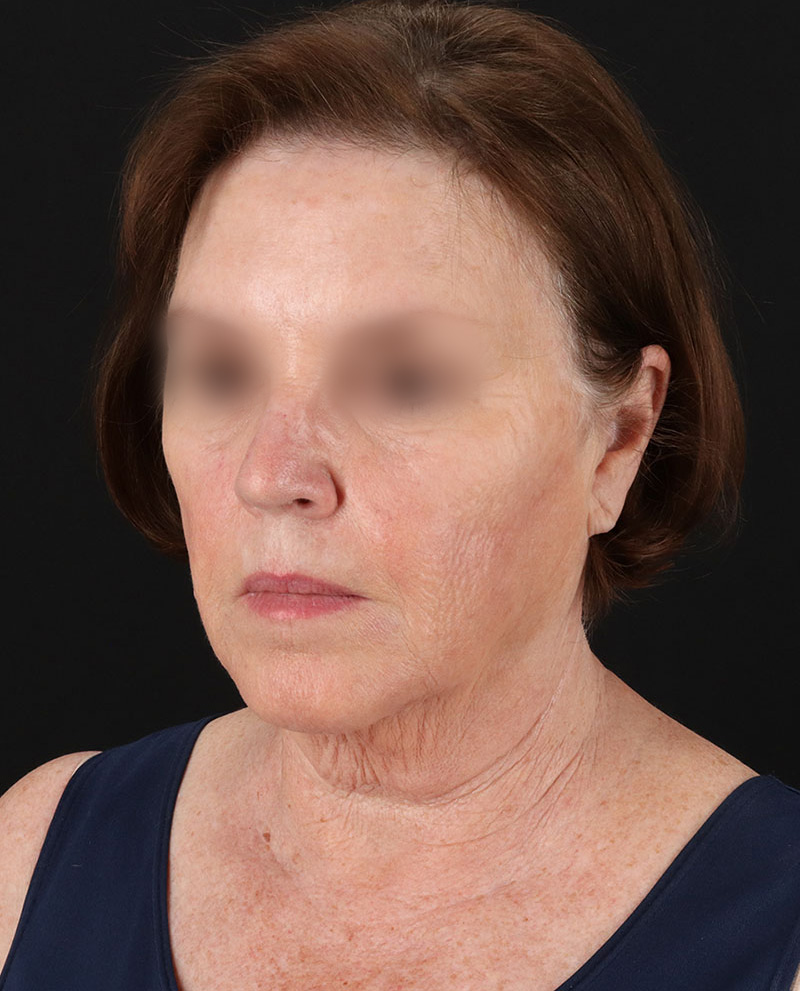 Facelift Before & After Patient #8954