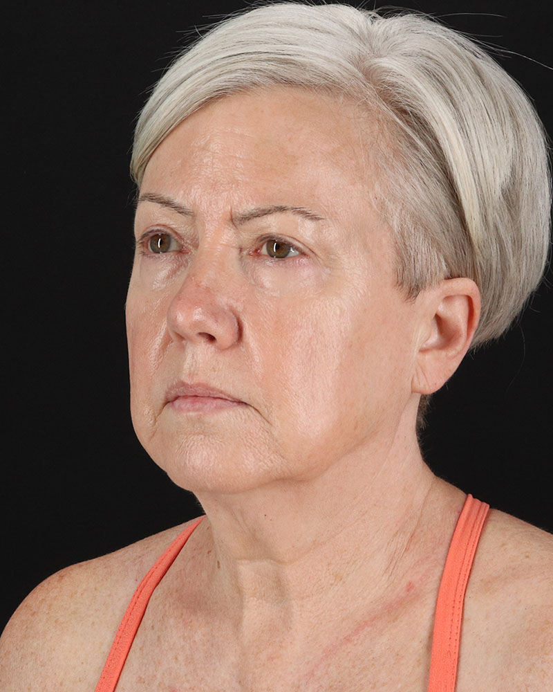 Facelift Before & After Patient #8946