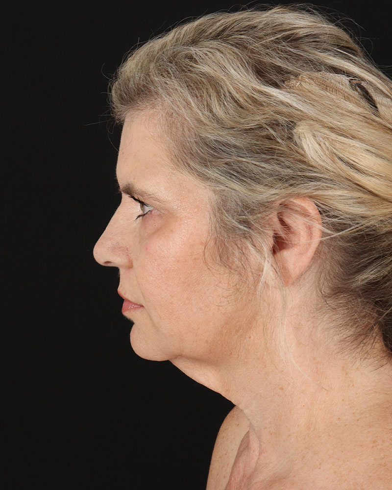 Facelift Before & After Patient #8947