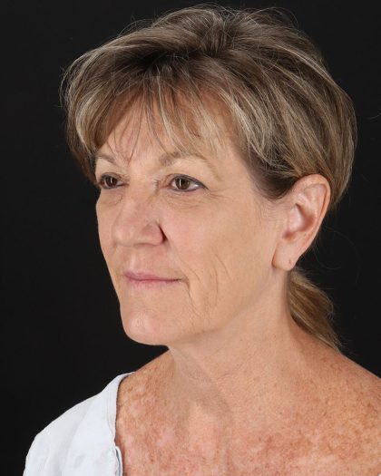 Facelift Before & After Patient #8948