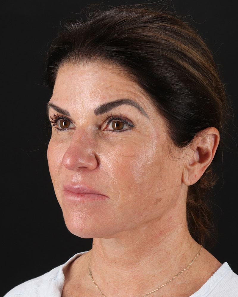 Facelift Before & After Patient #8949