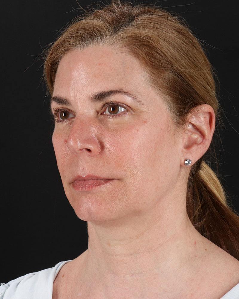 Lower Blepharoplasty Before & After Patient #8951