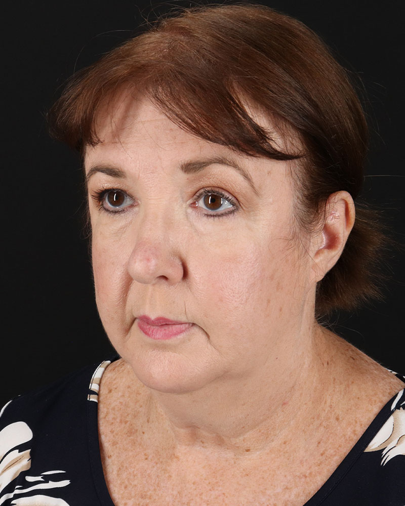Facelift Before & After Patient #8953