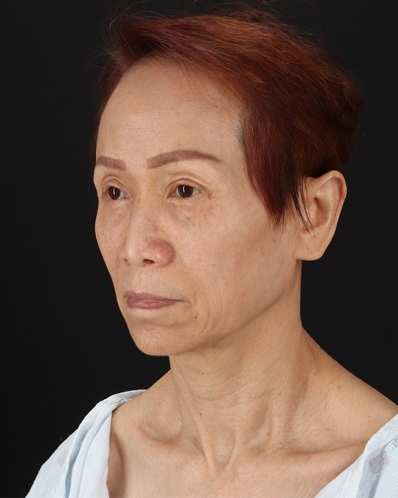 Facelift Before & After Patient #8950