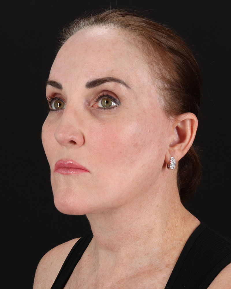 Facelift Before & After Patient #8943