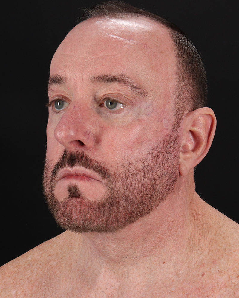 Facelift Before & After Patient #8955