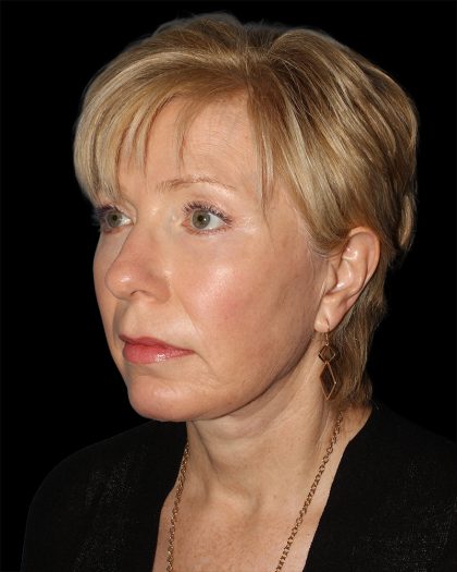 Facelift Before & After Patient #8958