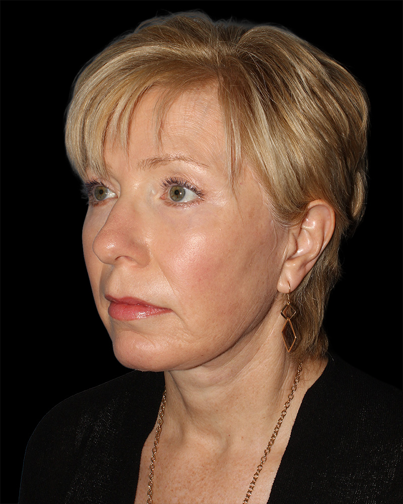 Facelift Before & After Patient #8958